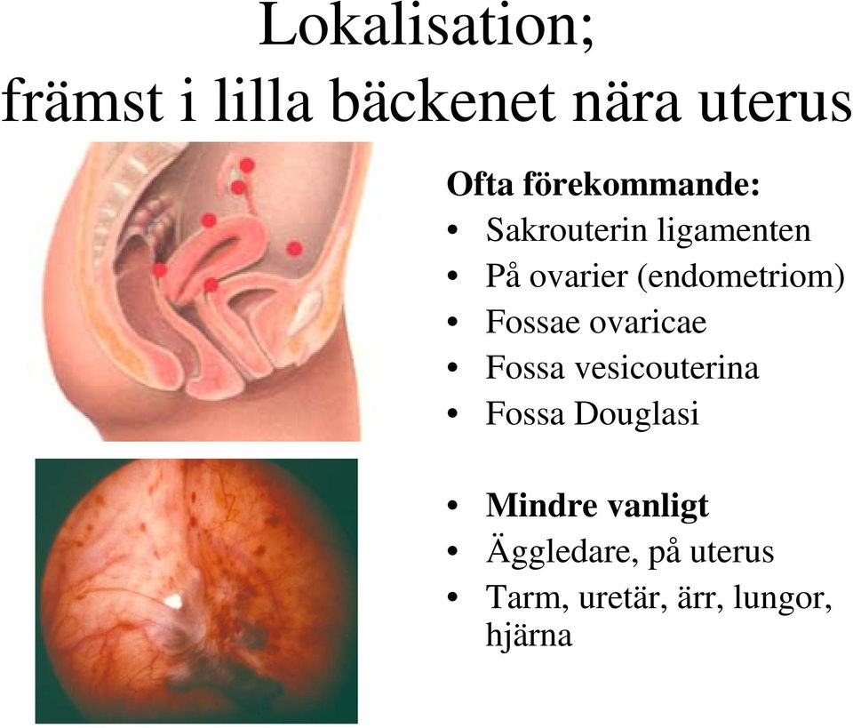 (endometriom) Fossae ovaricae Fossa vesicouterina Fossa