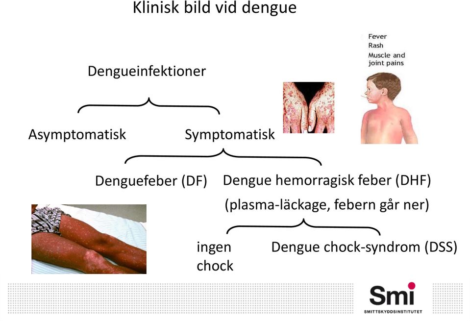 Dengue hemorragisk feber (DHF)