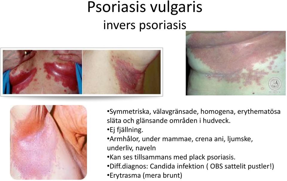 Armhålor, under mammae, crena ani, ljumske, underliv, naveln Kan ses tillsammans