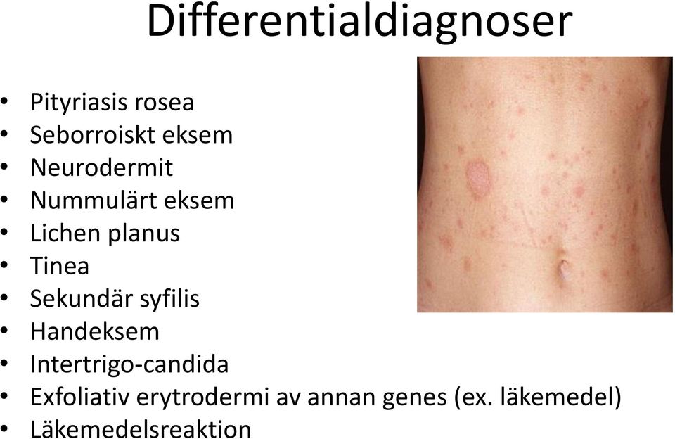 Sekundär syfilis Handeksem Intertrigo-candida