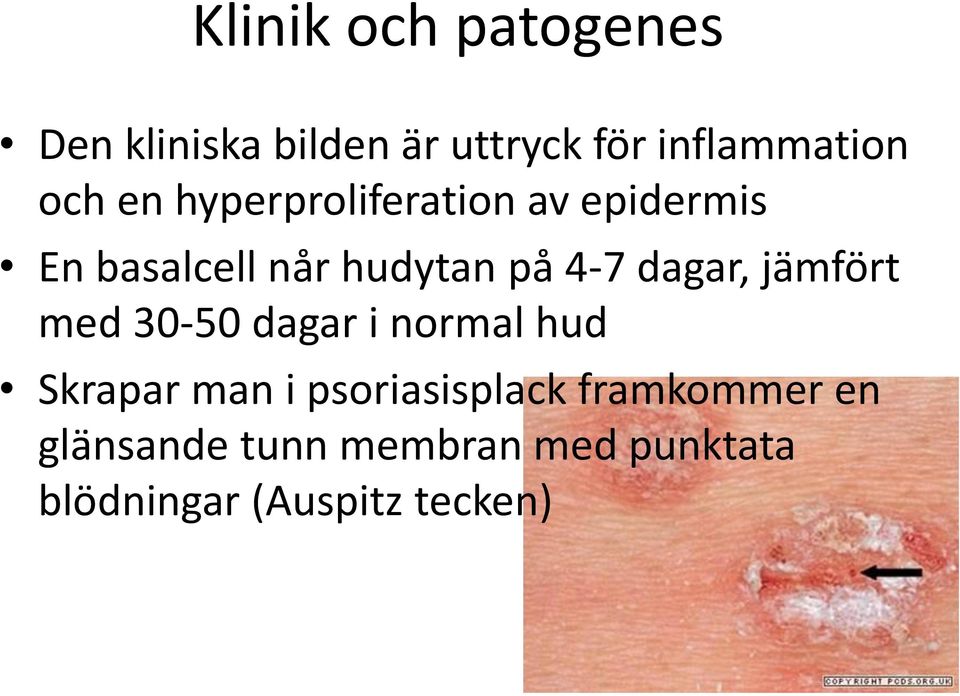 dagar, jämfört med 30-50 dagar i normal hud Skrapar man i psoriasisplack