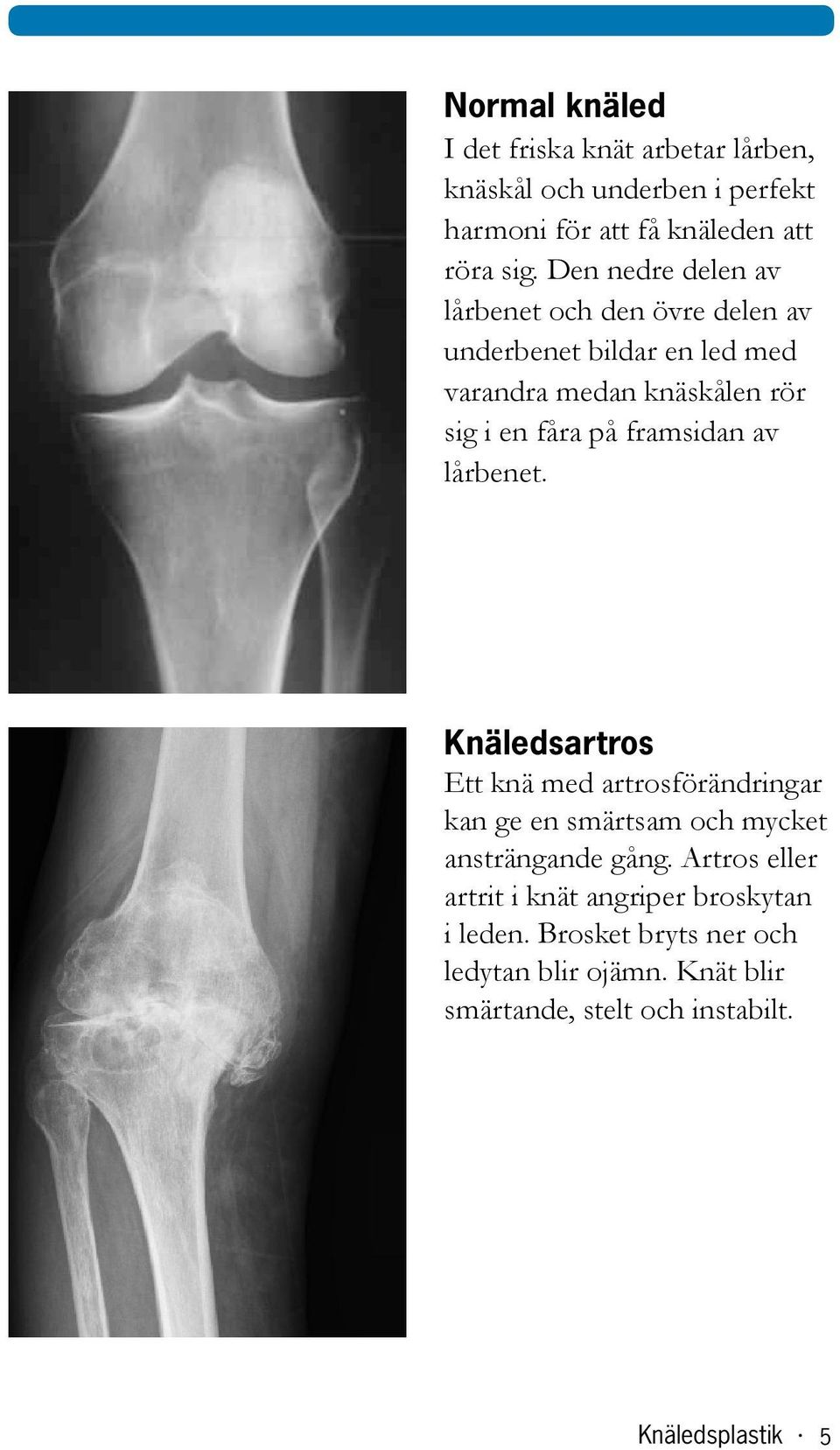 framsidan av lårbenet. Knäledsartros Ett knä med artrosförändringar kan ge en smärtsam och mycket ansträngande gång.