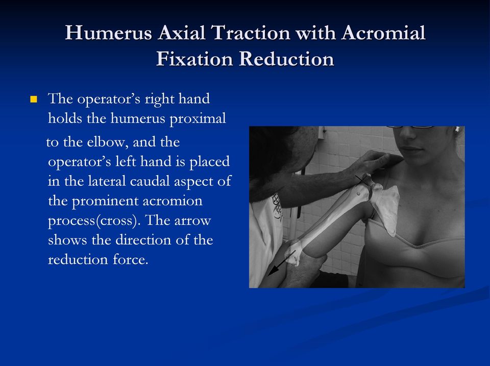 left hand is placed in the lateral caudal aspect of the prominent