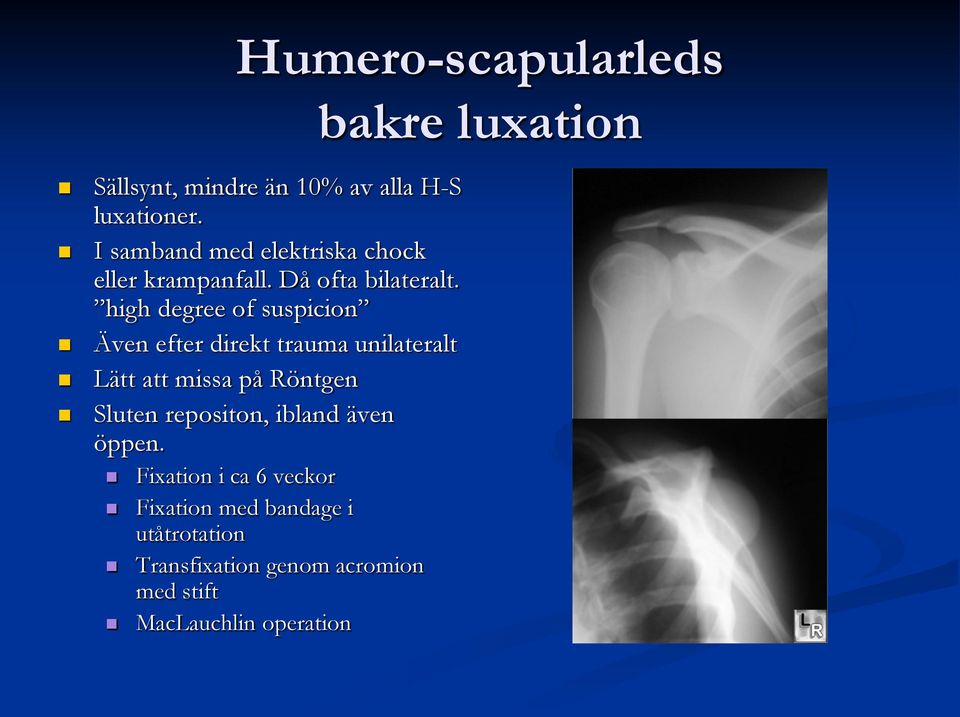 high degree of suspicion Även efter direkt trauma unilateralt Lätt att missa på Röntgen Sluten