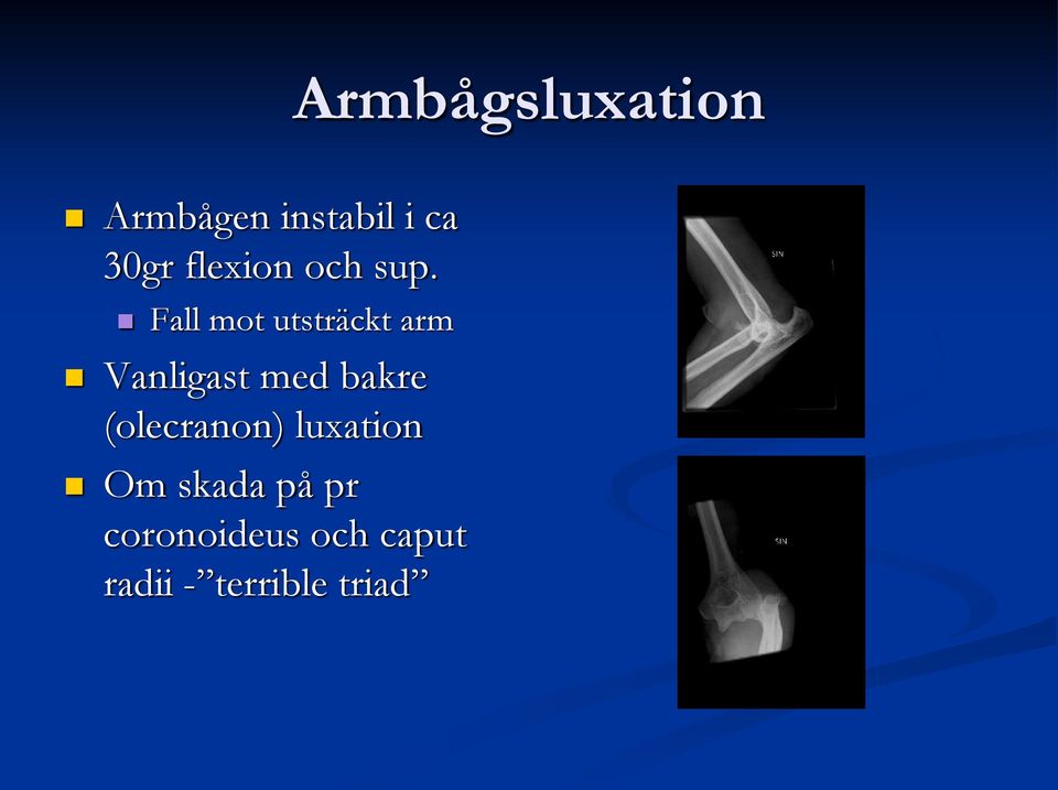 Fall mot utsträckt arm Vanligast med bakre