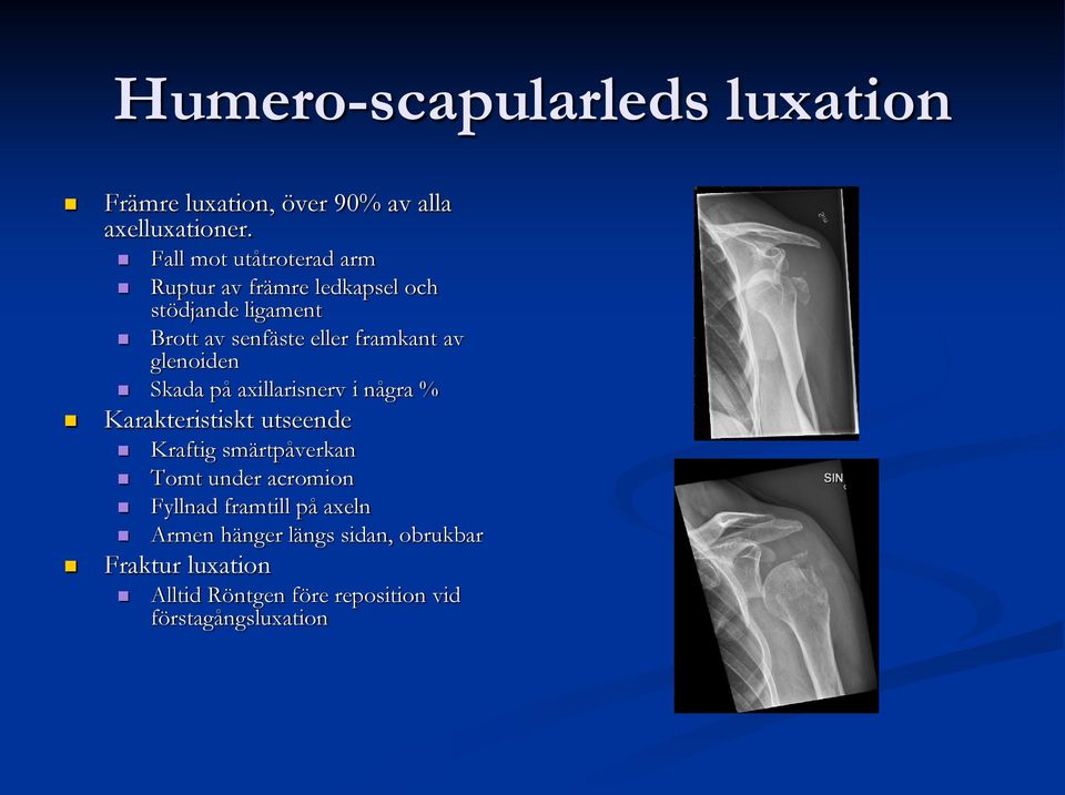 av glenoiden Skada på axillarisnerv i några % Karakteristiskt utseende Kraftig smärtpåverkan Tomt under