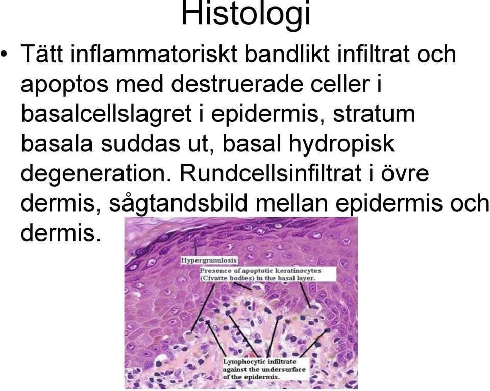 stratum basala suddas ut, basal hydropisk degeneration.