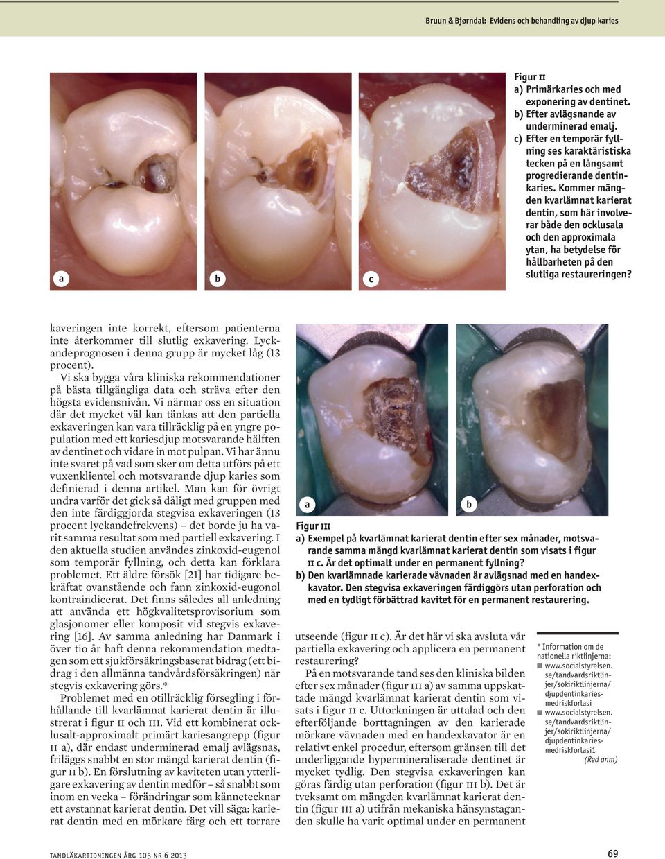 Kommer mängden kvarlämnat karierat dentin, som här involverar både den ocklusala och den approximala ytan, ha betydelse för hållbarheten på den slutliga restaureringen?