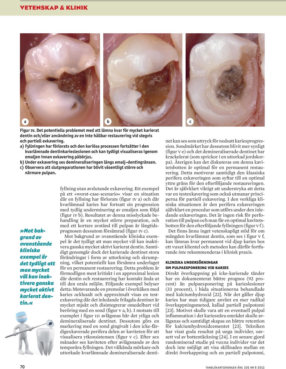 b) Under exkavering ses demineraliseringen längs emalj dentingränsen. c) Observera att slutpreparationen har blivit väsentligt större och närmare pulpan.
