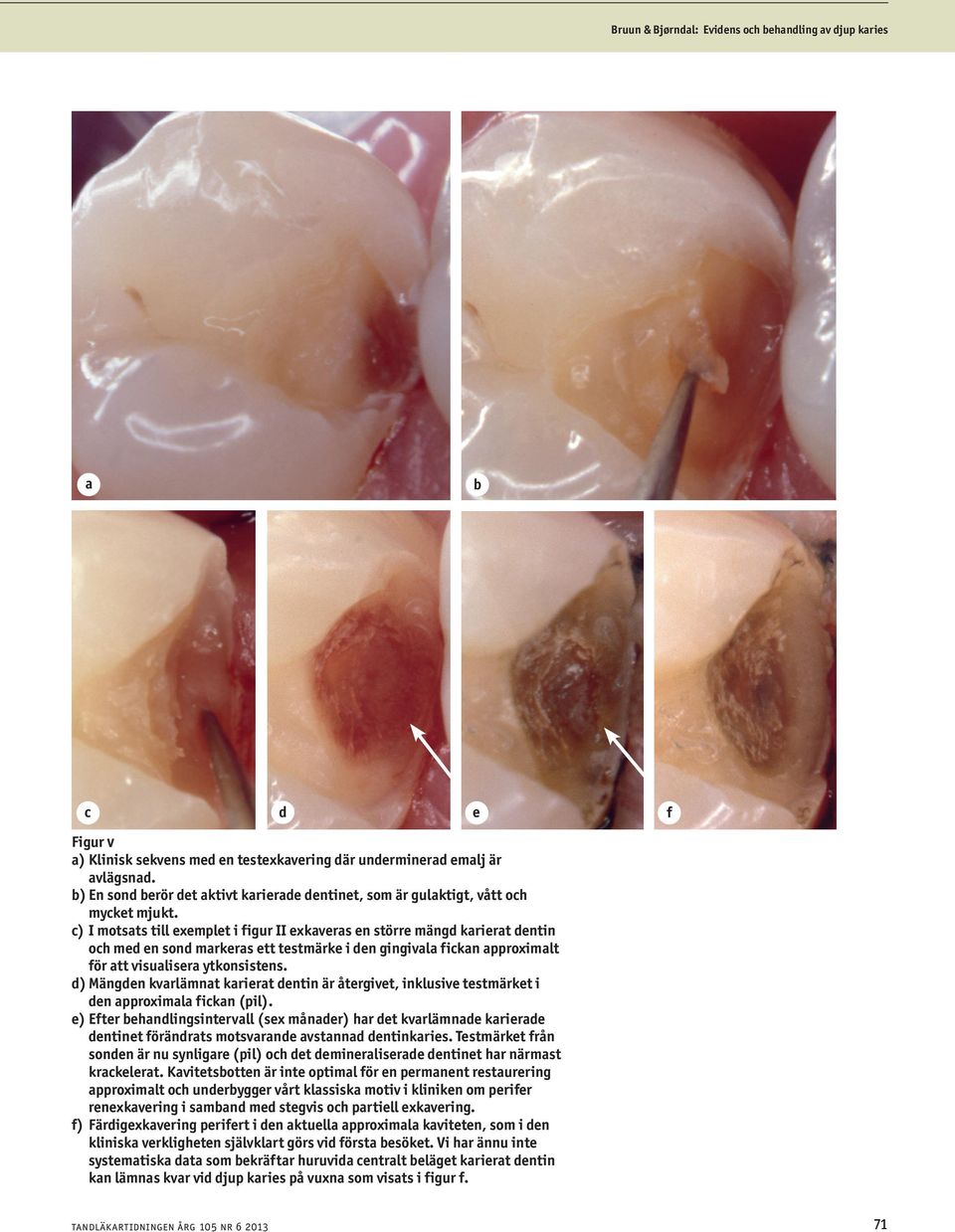 c) I motsats till exemplet i figur II exkaveras en större mängd karierat dentin och med en sond markeras ett testmärke i den gingivala fickan approximalt för att visualisera ytkonsistens.