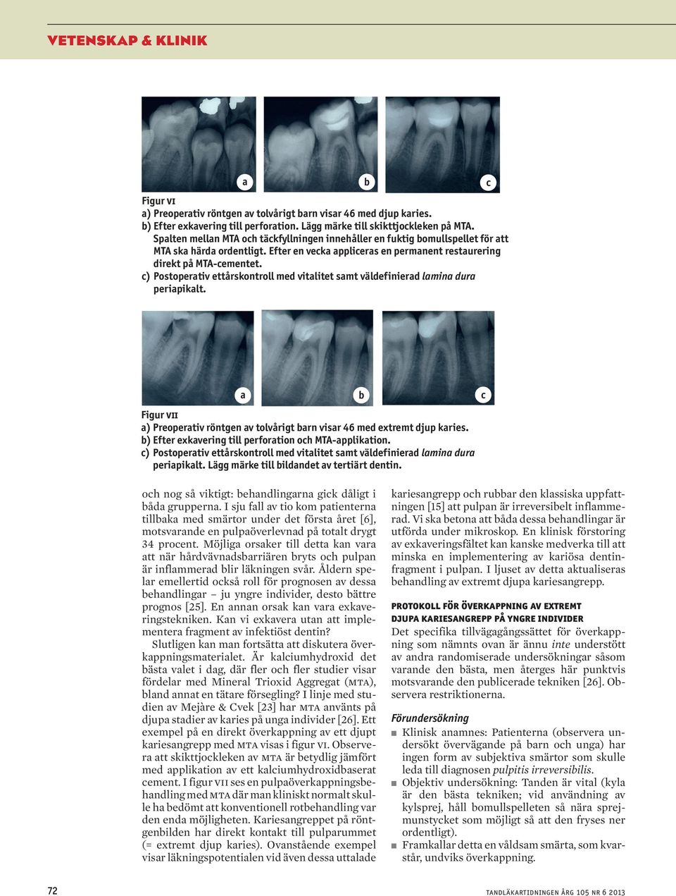 c) Postoperativ ettårskontroll med vitalitet samt väldefinierad lamina dura periapikalt. a b c Figur vii a) Preoperativ röntgen av tolvårigt barn visar 46 med extremt djup karies.