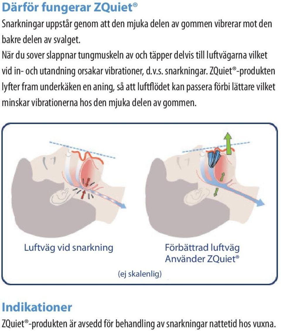 ZQuiet -produkten lyfter fram underkäken en aning, så att luftflödet kan passera förbi lättare vilket minskar vibrationerna hos den mjuka delen