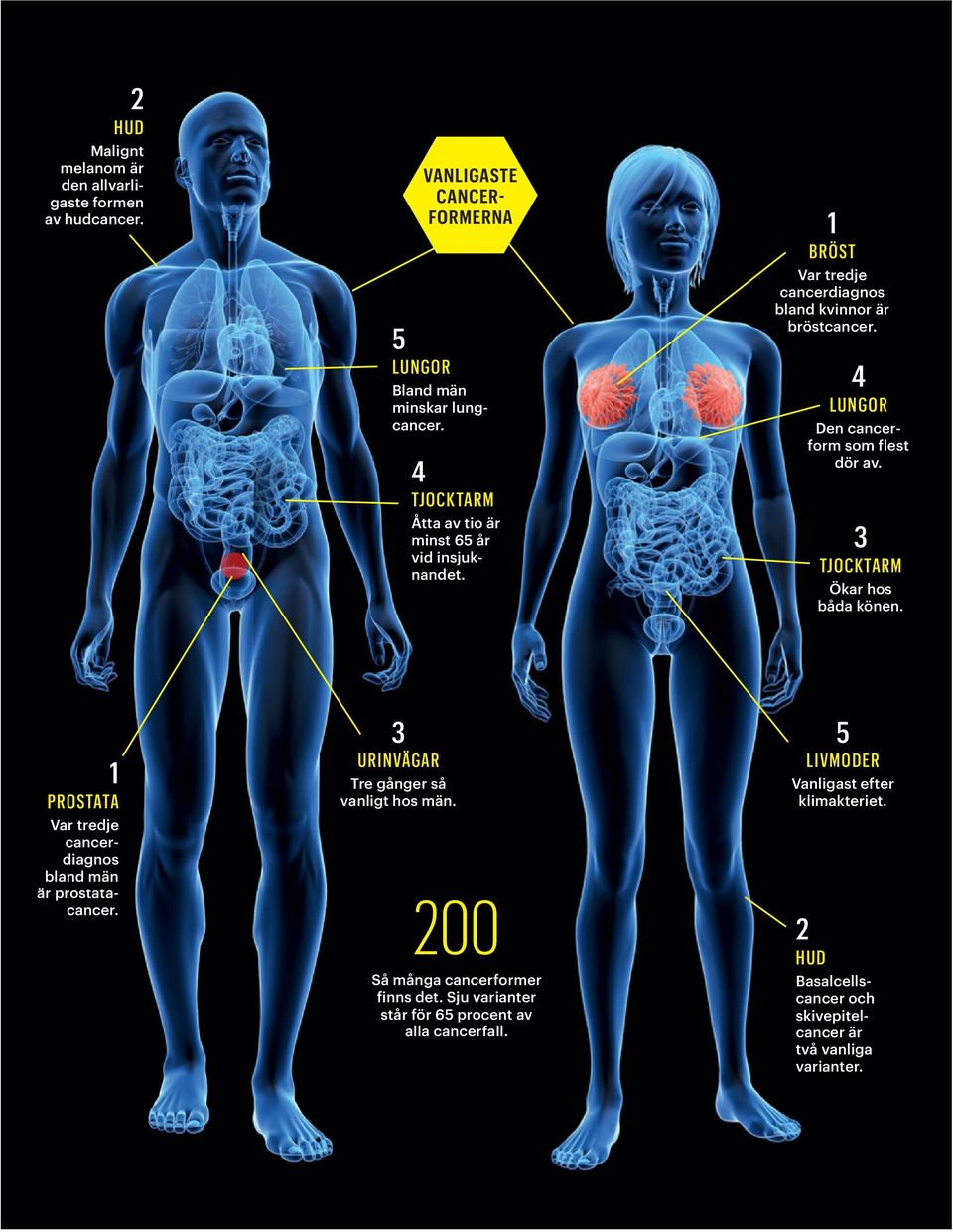 4 LUNGOR Den cancerform som flest dör av. 3 TJOCKTARM Ökar hos båda könen. 1 PROSTATA Var tredje cancerdiagnos bland män är prostatacancer.