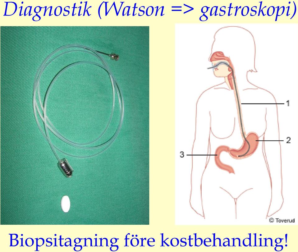 gastroskopi)