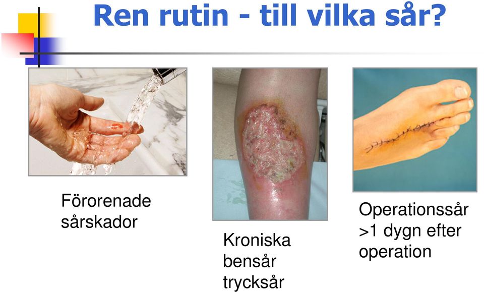 Kroniska bensår trycksår