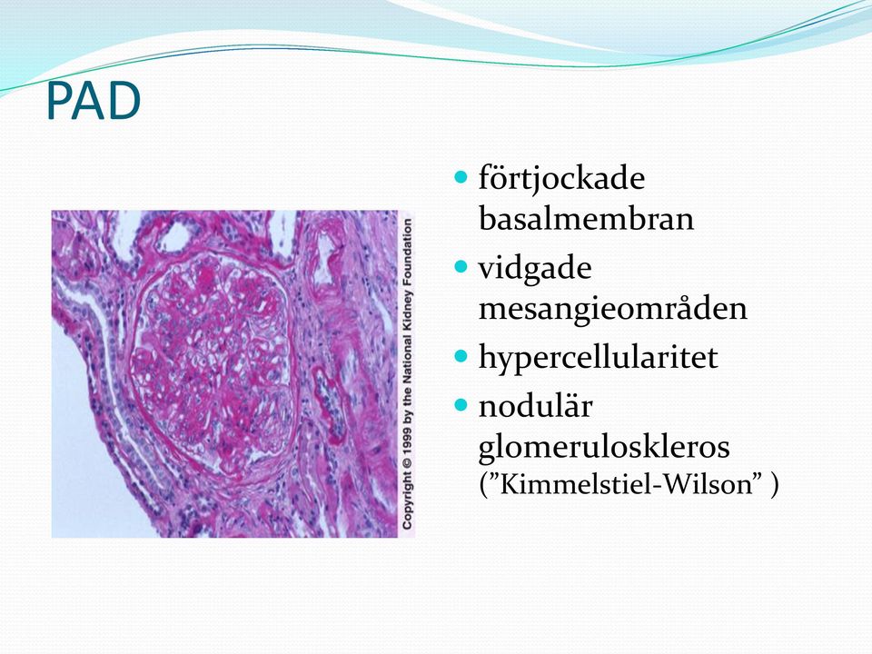 hypercellularitet nodulär