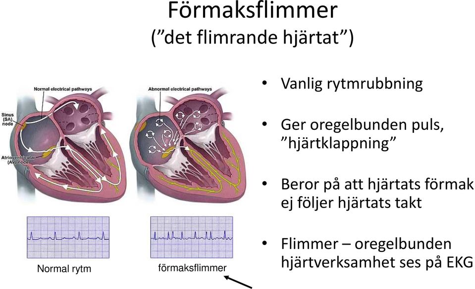 på att hjärtats förmak ej följer hjärtats takt Normal