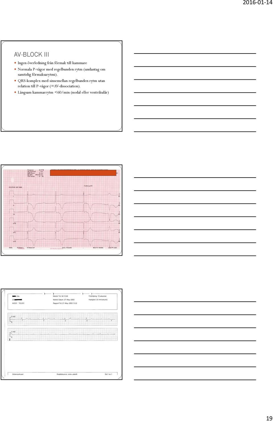 QRS-komplex med sinsemellan regelbunden rytm utan relation till