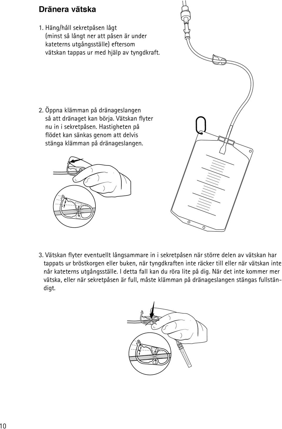 3. Vätskan flyter eventuellt långsammare in i sekretpåsen när större delen av vätskan har tappats ur bröstkorgen eller buken, när tyngdkraften inte räcker till eller när vätskan