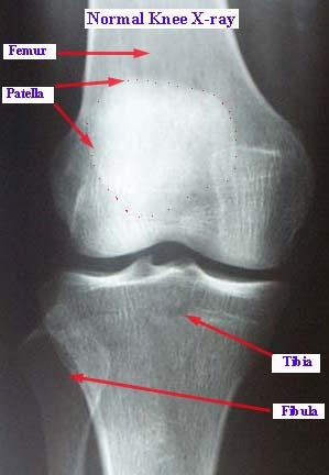 Artros T6 Osteoarthritis (OA) Vanligt