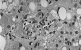 Levercirrhos 6. Maligna tumörer i lever och gallvägar - Primär levercancer: Relativt ovanligt; komplikation till kronisk hepatit B eller C eller till cirros av annan anledning.