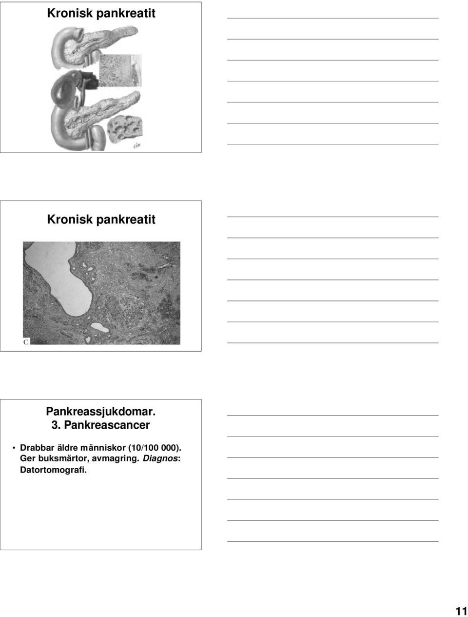 Pankreascancer Drabbar äldre människor