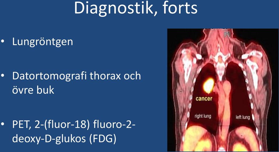 thorax och övre buk PET,