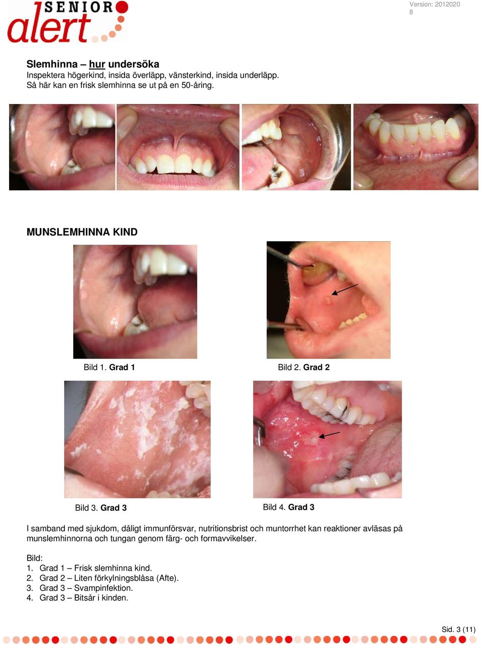 Grad 3 I samband med sjukdom, dåligt immunförsvar, nutritionsbrist och muntorrhet kan reaktioner avläsas på munslemhinnorna och