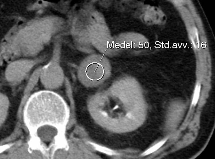 Adrenala incidentalom Radiologiskt appendix- Nationella rekommendationer 2015 6(13) Beräkningarna kan underlättas med hjälp av OmniBi i OmniVis-programmet (se figur).