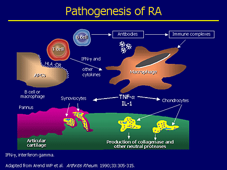 Rheumatoid Arthritis 0,5-1% of population