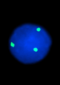 karyotypering är svårt vid KLL då delande celler
