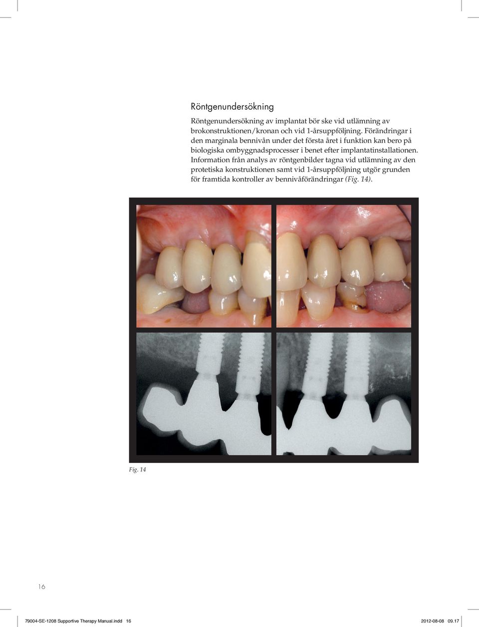 implantatinstallationen.