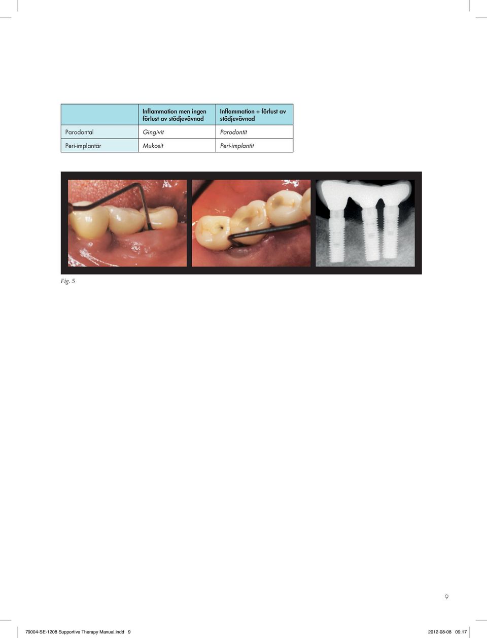 Gingivit Parodontit Peri-implantär Mukosit
