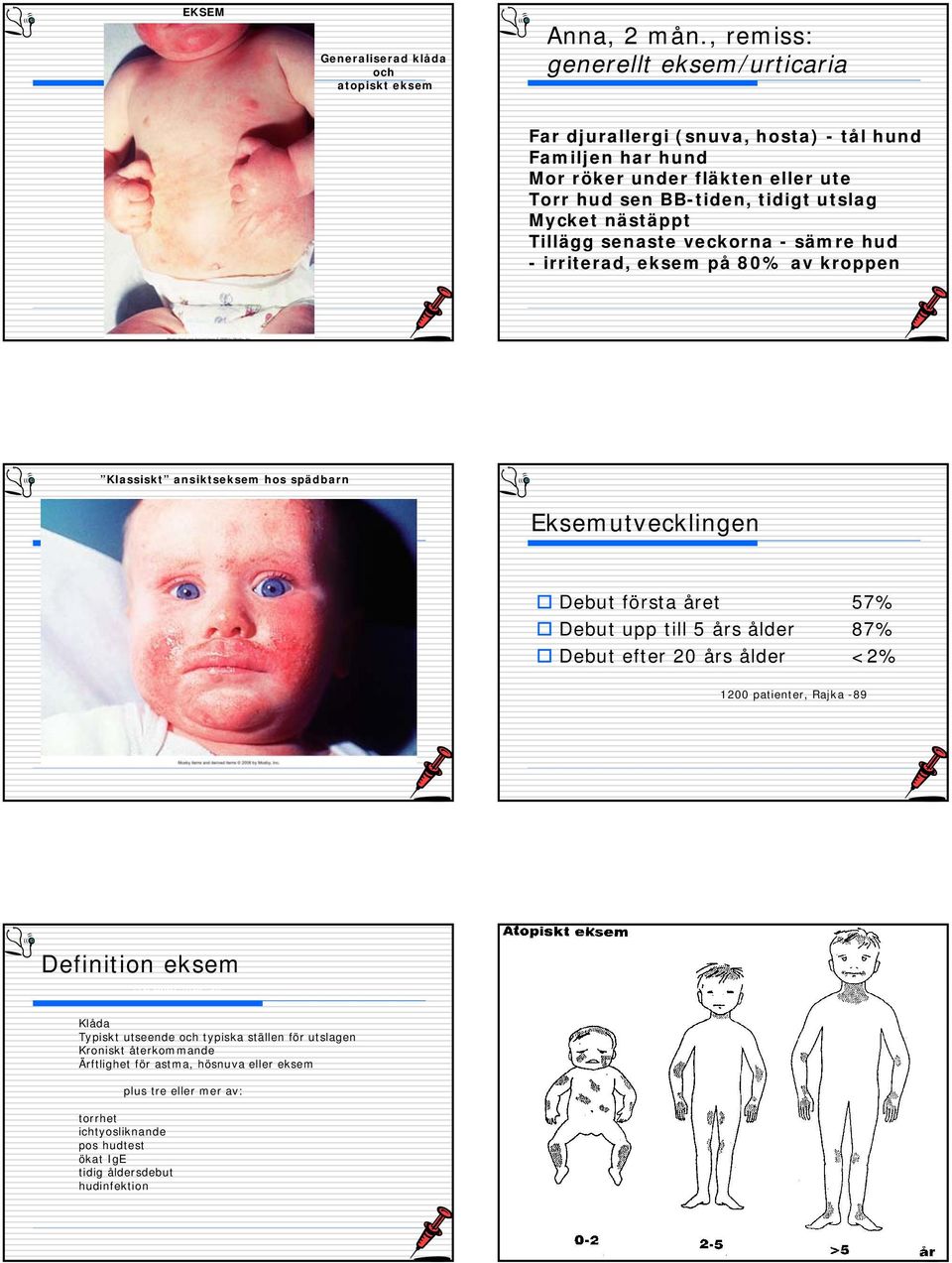 Tillägg senaste veckorna - sämre hud - irriterad, eksem på 80% av kroppen Klassiskt ansiktseksem hos spädbarn Eksemutvecklingen Debut första året 57% Debut upp till 5 års ålder 87%