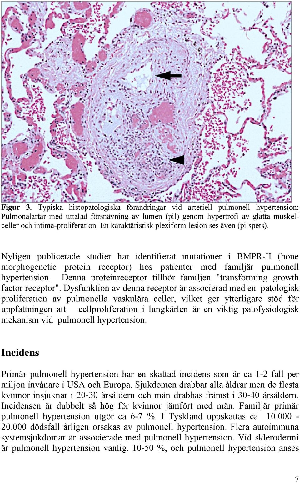 En karaktäristisk plexiform lesion ses även (pilspets).