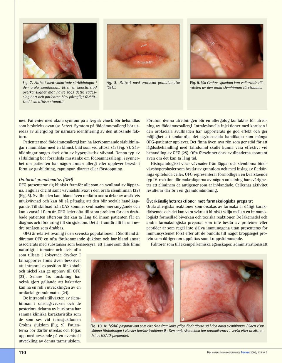 Vid Crohns sjukdom kan vallartade tillväxten av den orala slemhinnan förekomma. met. Patienter med akuta symtom på allergisk chock bör behandlas som beskrivits ovan (se Latex).