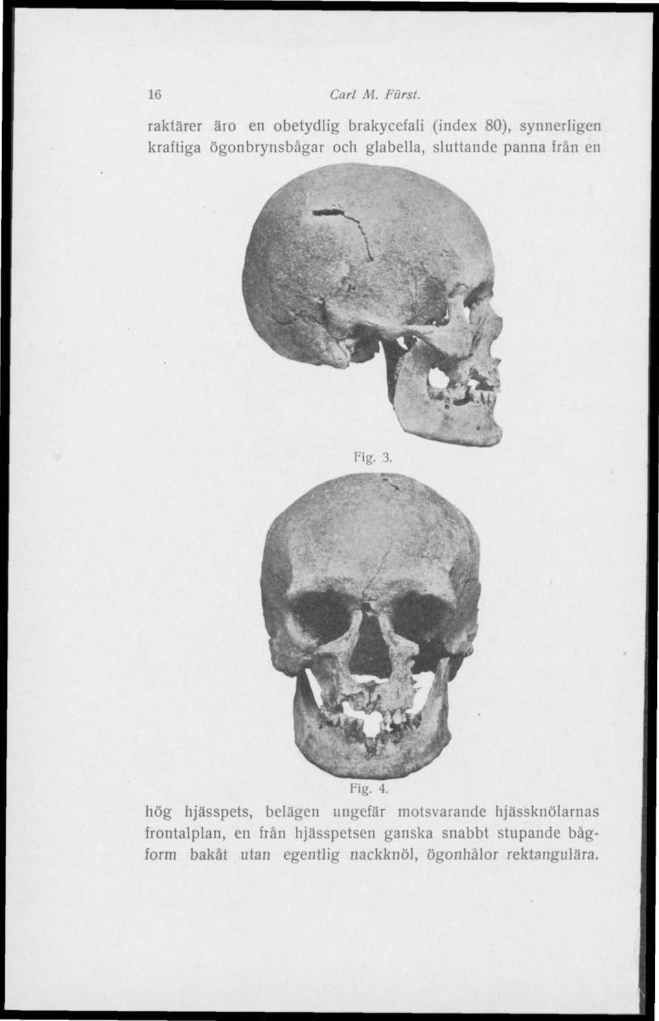 ögonbrynsbägar och glabella, sluttande panna från en Fig. 3.