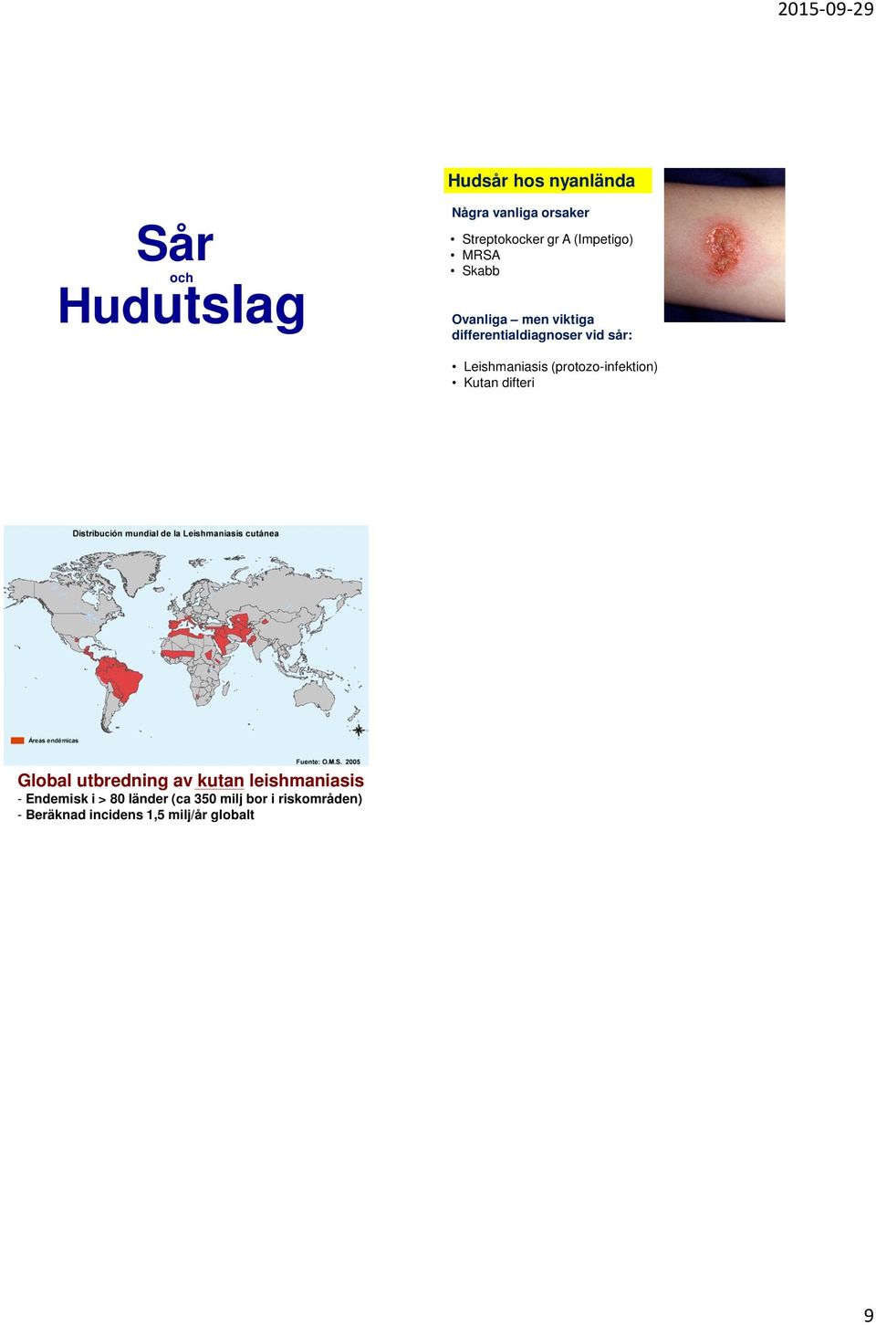 Leishmaniasis (protozo-infektion) Kutan difteri Global utbredning av kutan