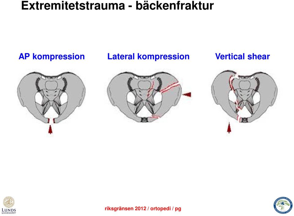 kompression Lateral