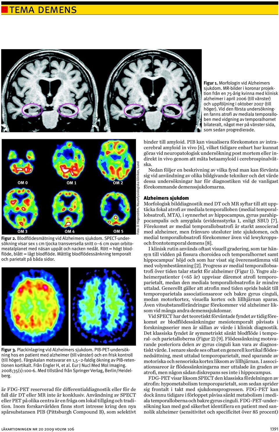 Blodflödesmätning vid Alzheimers sjukdom. SPECT-undersökning visar sex 1 cm tjocka transversella snitt 0 6 cm ovan orbitomeatalplanet med näsan uppåt och nacken nedåt.