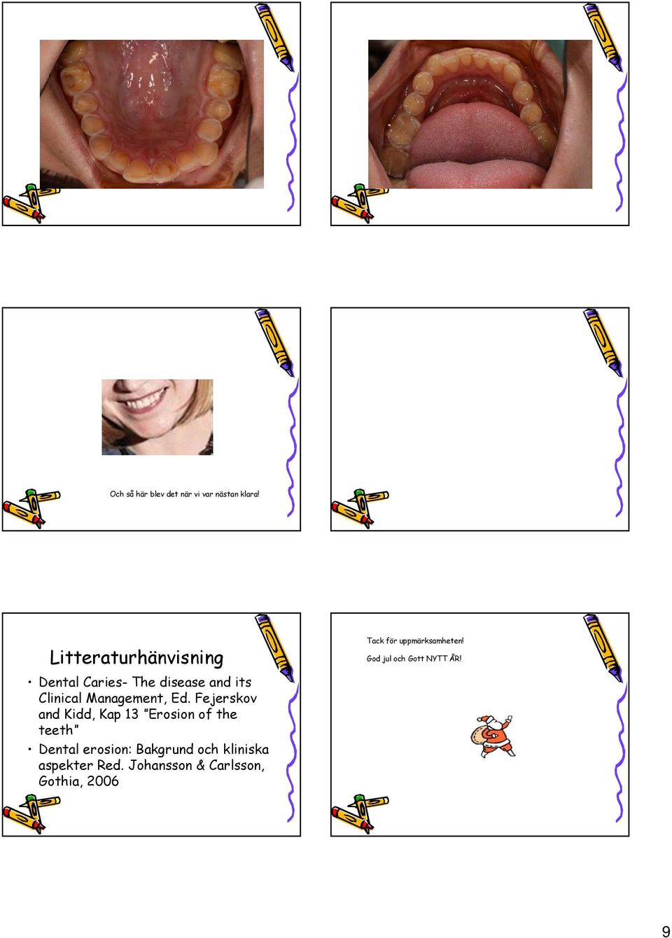 Ed. Fejerskov and Kidd, Kap 13 Erosion of the teeth Dental erosion: Bakgrund