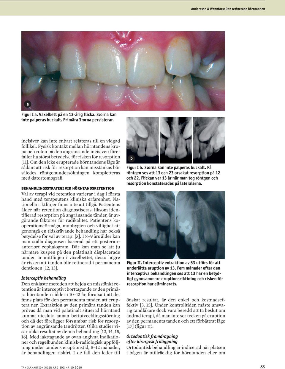 Om den icke erupterde hörntndens läge är sådnt tt risk för resorption kn misstänks ör således röntgenundersökningen kompletters med dtortomogrfi.
