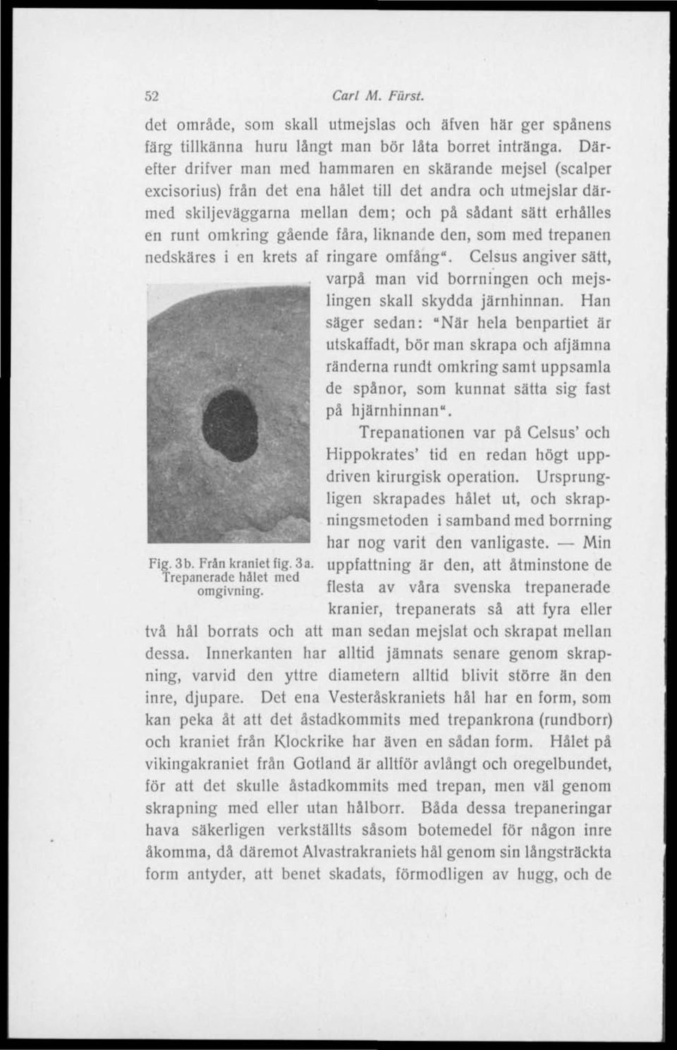 gående fåra, liknande den, som med trepanen nedskäres i en krets af ringare omfång". Celsus angiver sätt, varpå man vid borrningen och mejslingen skall skydda järnhinnan.