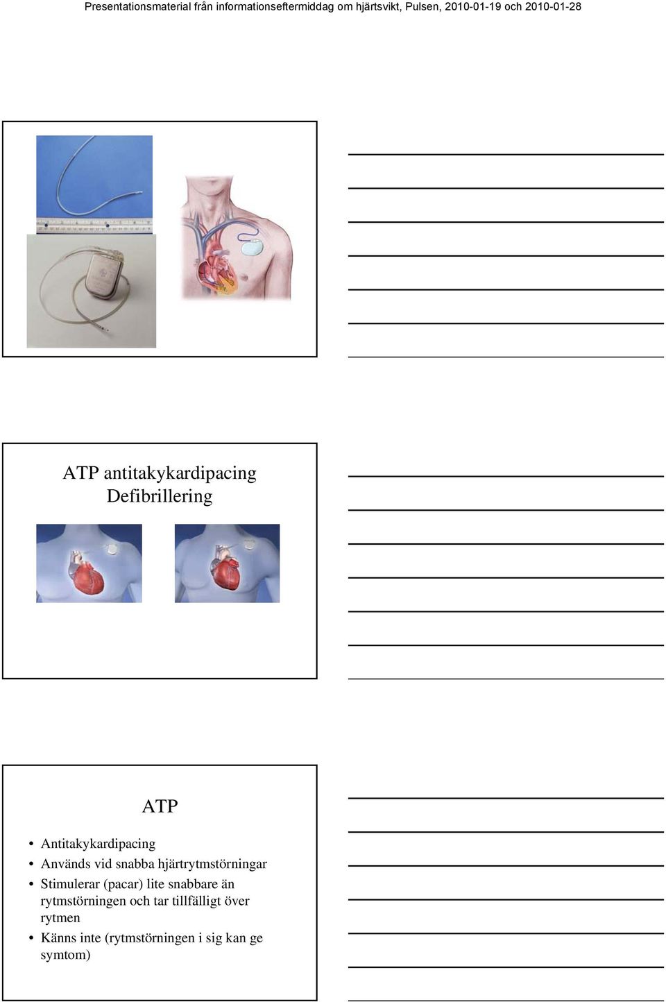 hjärtrytmstörningar Stimulerar (pacar) lite snabbare än