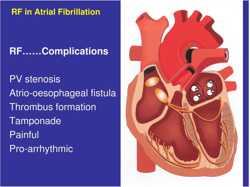 Atrio-oesophageal fistula