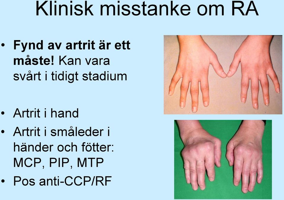 Kan vara svårt i tidigt stadium Artrit i