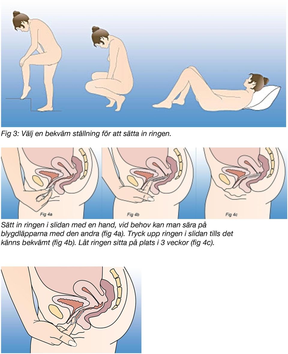 blygdläpparna med den andra (fig 4a).