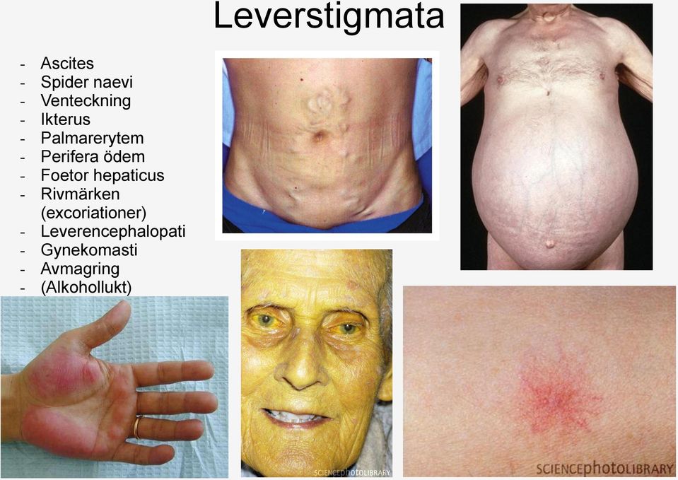 Rivmärken (excoriationer) - Leverencephalopati -