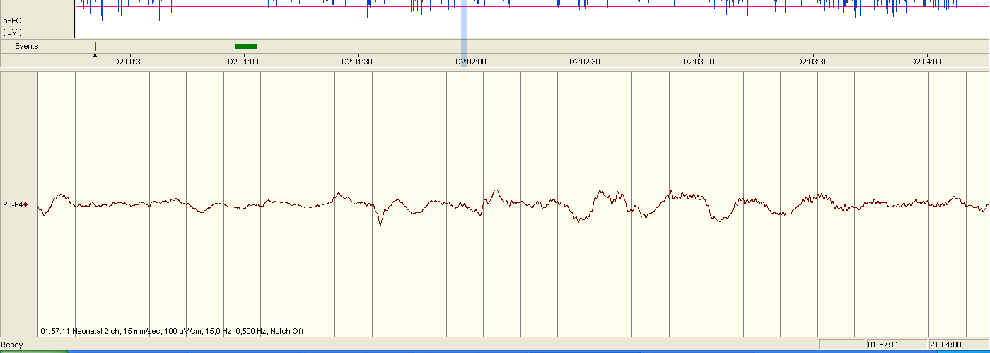 Omogen sleep-wake cycling GÅ 23+4 v (PNÅ 2 d) GÅ 25+3 v (PNÅ 2 d) GÅ 26+3 v (PNÅ 1 d) aeeg hos sjuka prematurer Asfyxi,