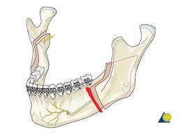 INLEDNING Bilateral sagittal split osteotomi vid ramus beskrevs första gången av Schuchardt 1942.